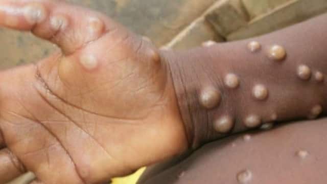 Monkeypox Outbreak: Is The Cessation of Smallpox Vaccination Behind It?